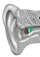 iic-hearing-aid.png